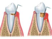 detartraj-dentar-artimplant
