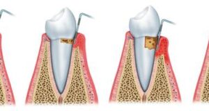 detartraj-dentar-artimplant