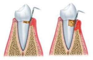 detartraj-dentar-artimplant