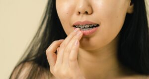 Aparatul dentar: tot ce trebuie să știi